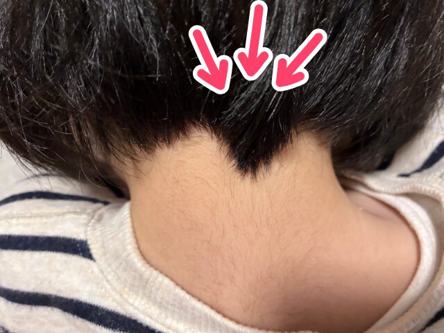 襟足のおたまじゃくし対処法