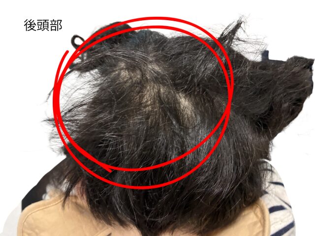 後頭部の髪の毛の絡まりを取る方法